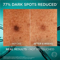 L’Oreal Revitalift Bright Reveal Serum 30ml for dark spots